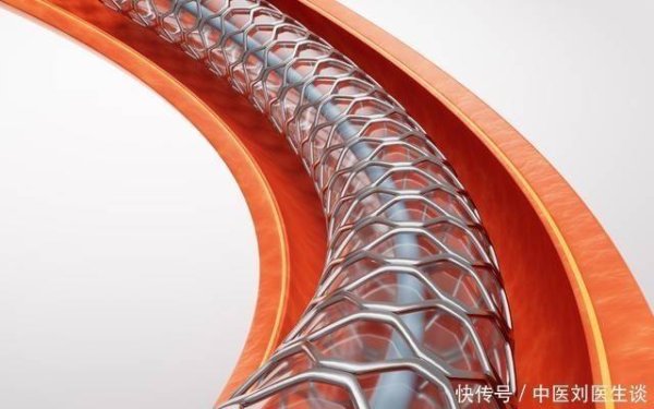 日升策略 心脏支架手术：到底是治病救人还是“缺德手术”